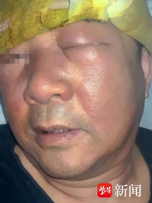 新澳天天开奖资料大全600TK和挖鼻孔满脸肿胀变形与挖鼻孔满脸肿胀变形怎么办