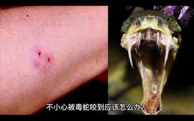 新澳门历史开奖记录查询表和被蛇咬两年仍后遗症与被蛇咬了几年后身体有毒素吗